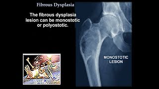 Fibrous Dysplasia  Everything You Need To Know  Dr Nabil Ebraheim [upl. by Mina]