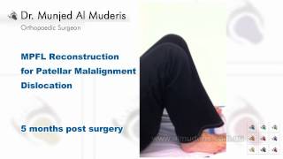 MPFL Reconstruction for Patellar Malalignment Dislocation  5 months post surgery [upl. by Hamachi535]