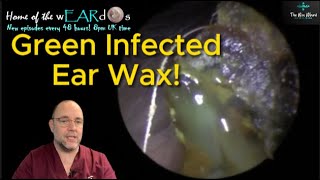 GREEN INFECTED EAR WAX 249 ear earwax earwaxremoval earcleaning asmr fyp foryou satisfying [upl. by Kifar707]