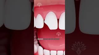 How Does Bonding Fix a Chipped Tooth shorts tooth  Creativelearning3d [upl. by Eiramacissej622]