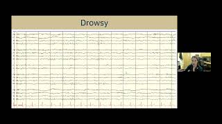 Understanding EEG A Practical Guide for Patients and Families [upl. by Noinatrad565]