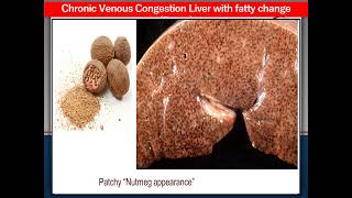 Bilharziasis UB Chronic venous congestion liver fatty change  Chronic rheumatic valvulitis [upl. by Ane]