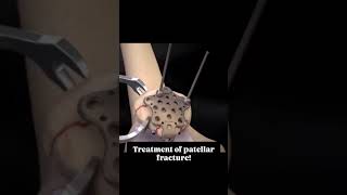 Treatment of patellar fractureshortvideovideo [upl. by Auahsoj489]