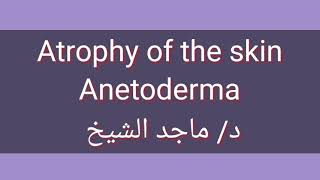 Atrophy of the skin  Anetoderma by Dr Maged El Sheikh [upl. by Kathie]