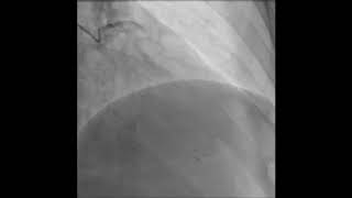 Coronary artery thrombosis aspiration Heart attack treatment  percutaneous coronary intervention [upl. by Atenek]