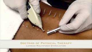 Lumbar Multifidus Stimulation [upl. by Nam604]