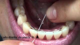 Como Passar Fio Dental no Dente com Aparelho  Orlando Tanaka [upl. by Alysa]