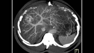 Abdomen LiverCT demonstrates a hemangioma of the liver because of the fatty infiltration10 of 10 [upl. by Ahseid]