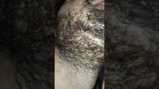 beard hair longer Carly problem beard hairproblem barber barbershop ingrownhair hairremoval [upl. by Rattan370]