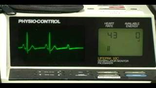 2nd Degree Type II Heart Block [upl. by Bozuwa519]