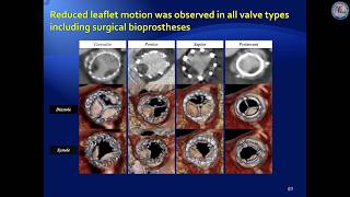 Pros and cons of transcatheter aortic valve implantation [upl. by Armalla130]