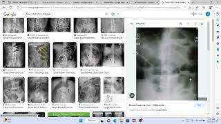 Surgery 4 MTB Cholelithiasis cholangitis obstructive jaundice [upl. by Frager]