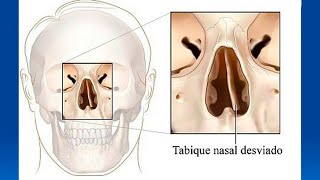 Causas y tratamientos del tabique desviado [upl. by Inman]