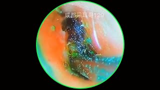 Satisfying Ear Wax Removal With Dr Zhao Video 120 [upl. by Sabina]