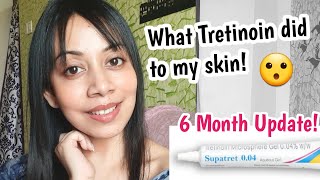 Tretinoin cream Before and After 6 Month update Supatret Tretinoin microsphere gel 004 ww [upl. by Elleynod19]