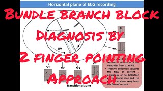 Diagnosis of Bundle branch block by two finger pointing approach by Dr Khaitan [upl. by Monah224]