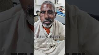 Facial paralysis mbbsstudent mbbs bellspalsy facialparalysis [upl. by Ratep645]