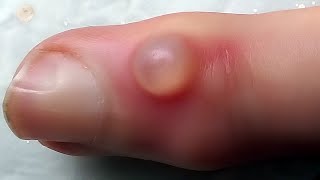 Infected Cyst Popping Extraction [upl. by Annaj]