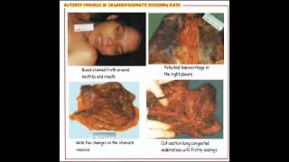 Autopsy In Case OP Poisoning Forensic Medicine amp Toxicology [upl. by Trout]