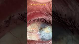 Corneal opacity after keratoplasty [upl. by Navets]