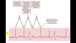 EKG EXTRASYSTOLES [upl. by Ailekahs513]