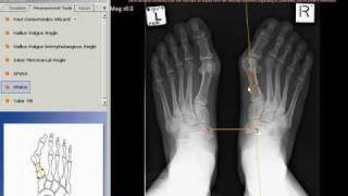 TraumaCad  Proximal Metatarsal Articular Angle [upl. by Gannie]