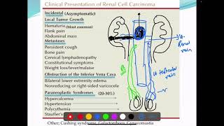 Renal cell carcinoma  RCC part 2  Diagnosis— clinical features amp investigation [upl. by Sergias357]