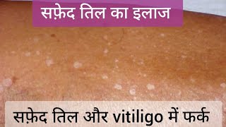 Idiopathic Guttate Hypomelanosis IGH सफ़ेद तिल और Vitiligo  Leucoderma और IGH vitiligo leucoderma [upl. by Enyalahs]