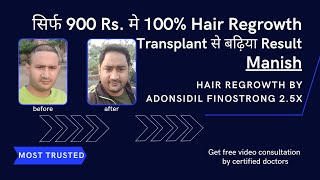 लाखों खर्च करने के बाद आखिर में रिजल्ट तो मुझे ADON से ही मिला  Best Minoxidil  Best Hair growth [upl. by Irah]