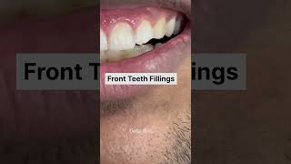 Amazing Quick Tooth Restoration dental dentist dentistry [upl. by Fe]