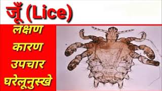 जूँ ka assan ilaj in hindi  easy treatment of lice in hindi  causes  home remedy [upl. by Sirraj]