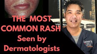 How to treat Perioral Dermatitis Dermatologist Explains [upl. by Rosalee280]