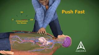 CPR cardiopulmonary resuscitation  3D animation [upl. by Levitus850]