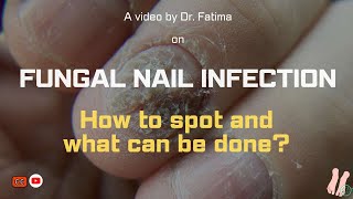 FUNGAL NAIL infection How to spot and What can be done [upl. by Everick]