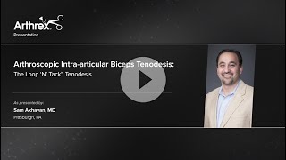 Arthroscopic Intraarticular Biceps Tenodesis The Loop N Tack™ Tenodesis [upl. by Seldan]