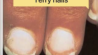 Quick review of Paronychia  Clubbing of fingers Melanonychiaonycholysis terry nails  pitting [upl. by Enovi747]