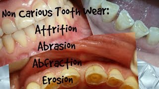 Non Carious Tooth WearAttrition Abrasion Abfraction ErosionClinical Appearance Diagnosis [upl. by Lishe565]