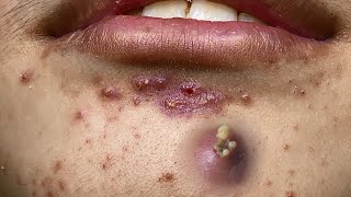 Big Cystic Acne Blackheads Extraction Blackheads amp Milia Whiteheads Removal Pimple Popping [upl. by Annis490]