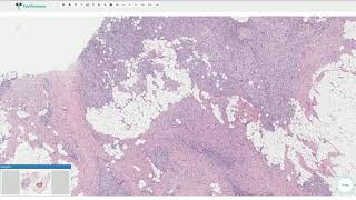 Fibrous Hamartoma of Infancy  Histopathology [upl. by Apthorp]