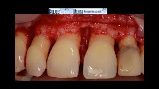 Periodontal Surgery Upper Front Teeth [upl. by Davis]