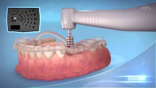 MIS Implants MGUIDE guided Implant placement procedure [upl. by Bass21]