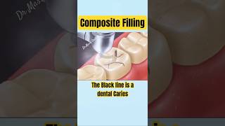 COMPOSITE FILLING on Molar tooth [upl. by Aicinod]