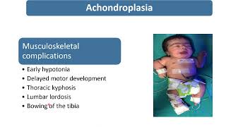 Achondroplasia  Spot Diagnosis  17  Pediatrics [upl. by Erihppas]