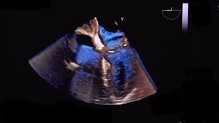 Lipomatous hypertrophy of the atrial septum LHAS [upl. by Drucilla]