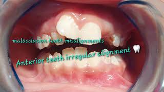 Mixed dentition stage variations congenital missing upper left lateral incisor improper alignments [upl. by Ellenrahs]