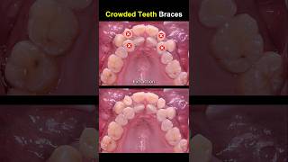 Complex braces for crowded teeth braces orthodontist dentist [upl. by Araet716]