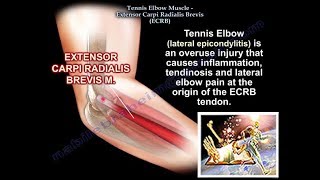 Tennis Elbow Extensor Carpi Radialis Brevis Everything You Need To Know  Dr Nabil Ebraheim [upl. by Sellers]