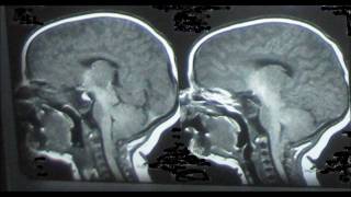 Arnold Chiari Malformation [upl. by Hillary]