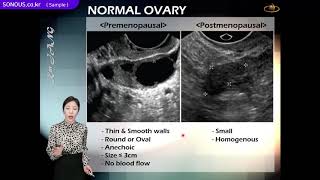 초음파교육난소초음파 Ovary Anatomy 강의 샘플영상  SONOUS 소노어쓰  대표강사  장경미 [upl. by Dorcia]