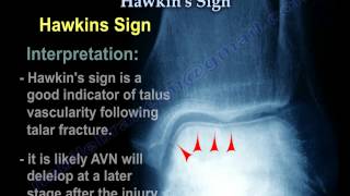 Talus Fracture  Hawkins Sign  Everything You Need To Know  Dr Nabil Ebraheim [upl. by Nosle599]